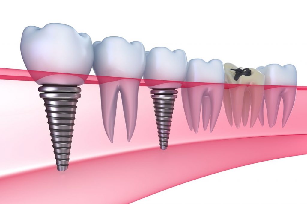 The facts about dental implants (prosthetics)