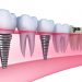 The facts about dental implants (prosthetics)