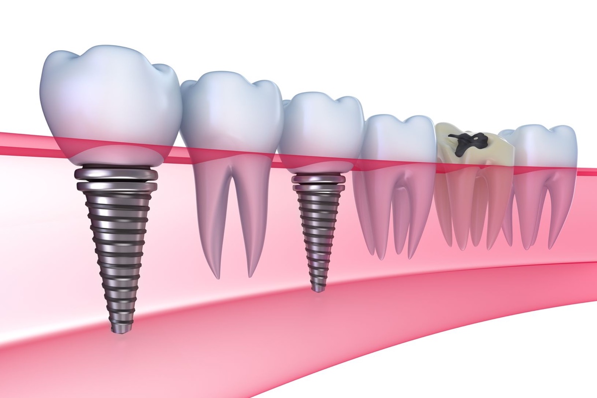The facts about dental implants (prosthetics)