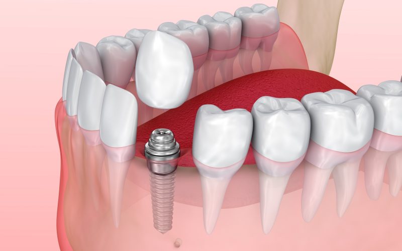 Diagram of a tooth implant