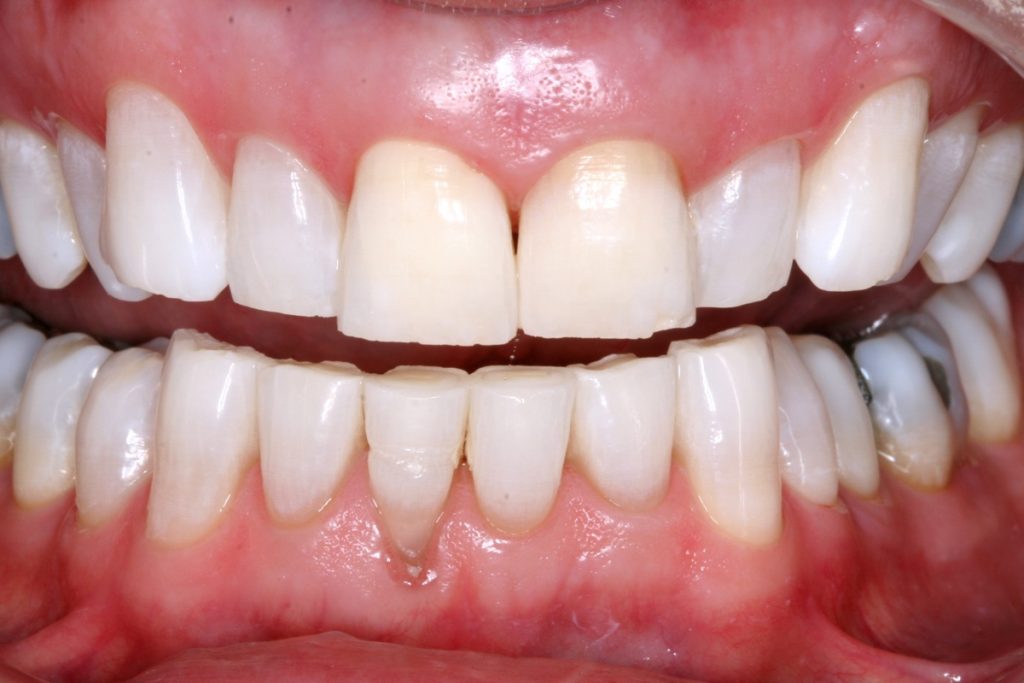 Teeth whitening treatment